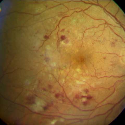 fortgeschrittene diabetische Retinopathie