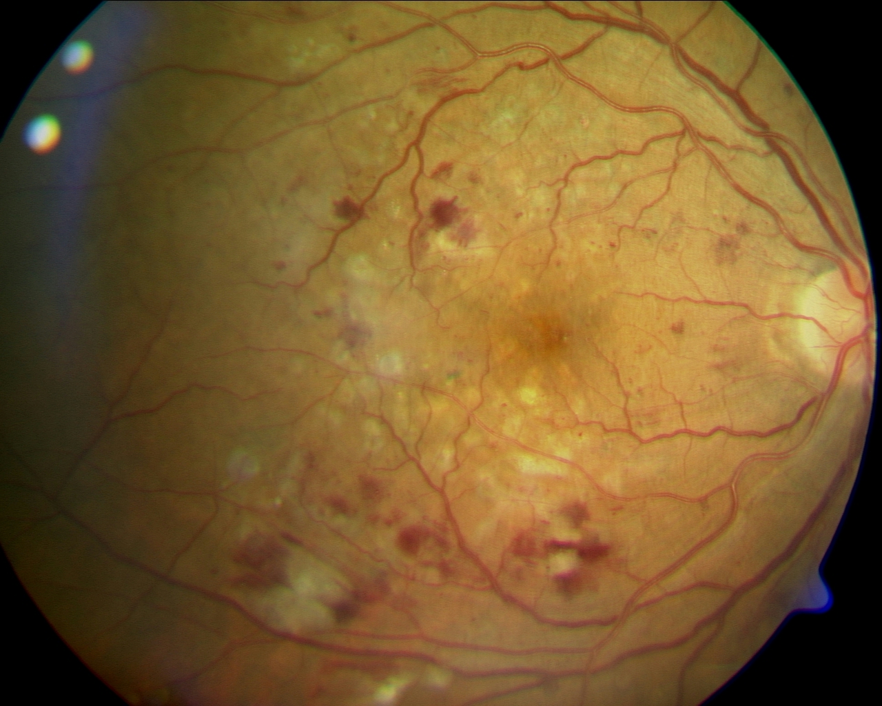 fortgeschrittene diabetische Retinopathie