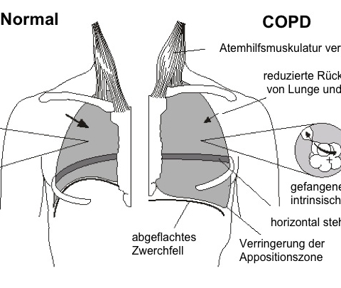 Störung der Lungenfunktion durch COPD