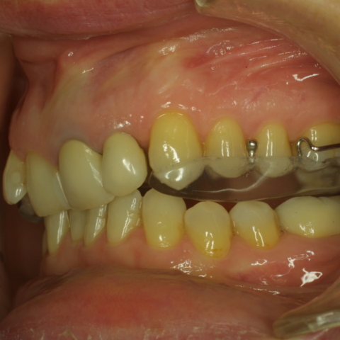 innovative Zahnschiene