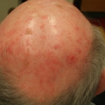 Skalp mit vielen aktinischen Keratosen (rötlich, rauhe, schuppende teils krustige Stellen)